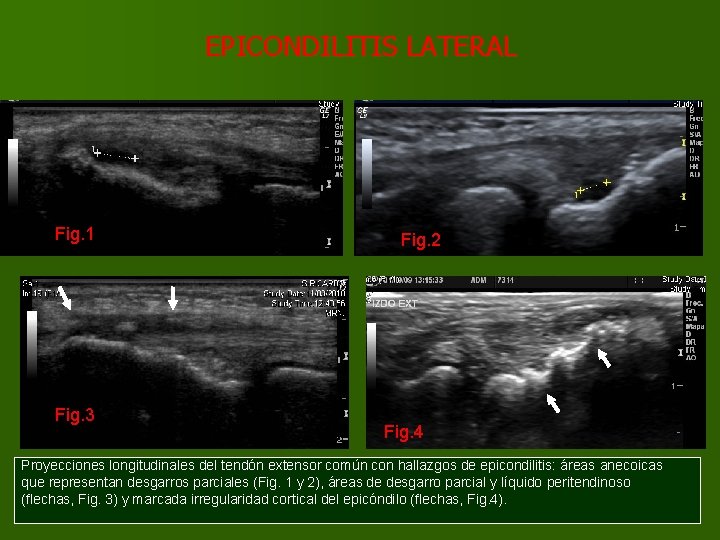 EPICONDILITIS LATERAL Fig. 1 Fig. 3 Fig. 2 Fig. 4 Proyecciones longitudinales del tendón