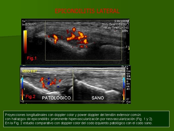 EPICONDILITIS LATERAL Fig. 1 Fig. 2 PATOLÓGICO SANO Proyecciones longitudinales con doppler color y