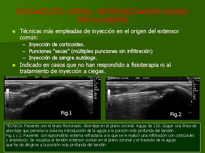 EPICONDILITIS LATERAL. INTERVENCIONISMO GUIADO POR ECOGRAFÍA n Técnicas más empleadas de inyección en el