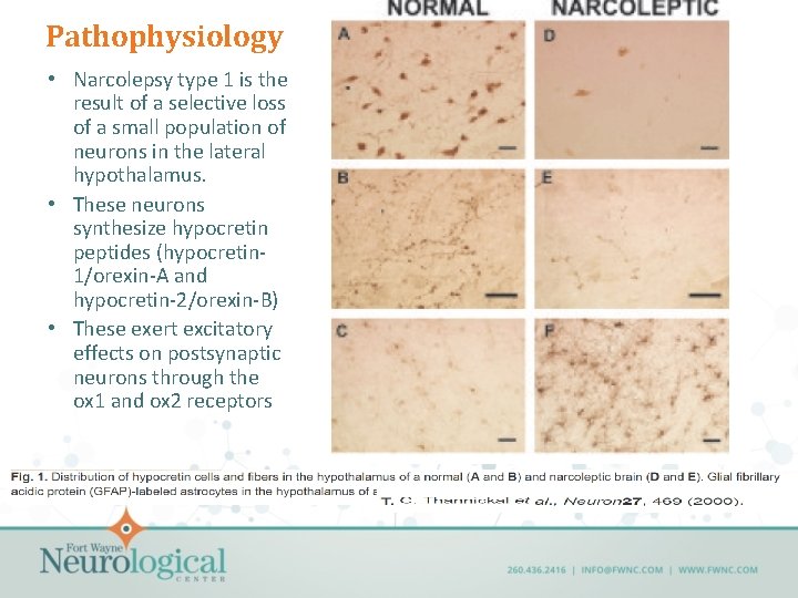 Pathophysiology • Narcolepsy type 1 is the result of a selective loss of a