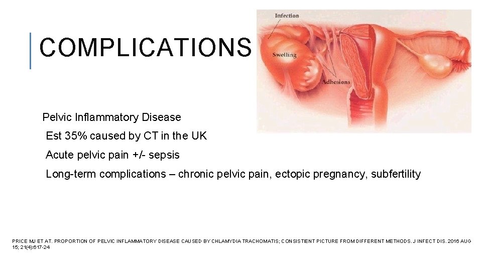 COMPLICATIONS Pelvic Inflammatory Disease Est 35% caused by CT in the UK Acute pelvic