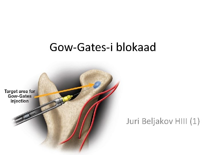 Gow-Gates-i blokaad Juri Beljakov HIII (1) 