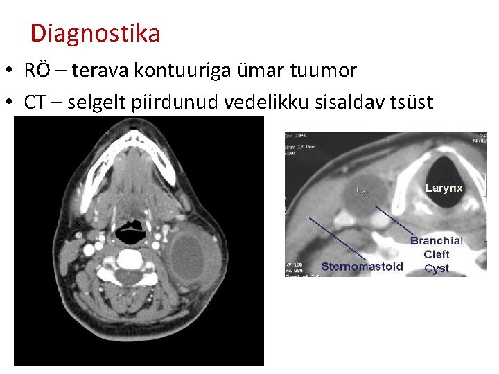 Diagnostika • RÖ – terava kontuuriga ümar tuumor • CT – selgelt piirdunud vedelikku