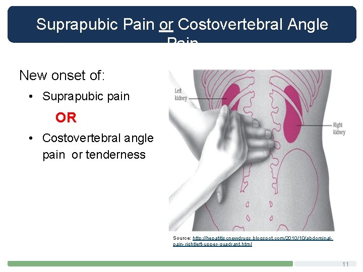 Suprapubic Pain or Costovertebral Angle Pain New onset of: • Suprapubic pain OR •