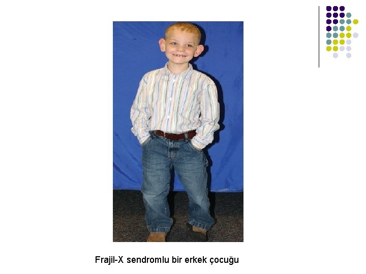Frajil-X sendromlu bir erkek çocuğu 