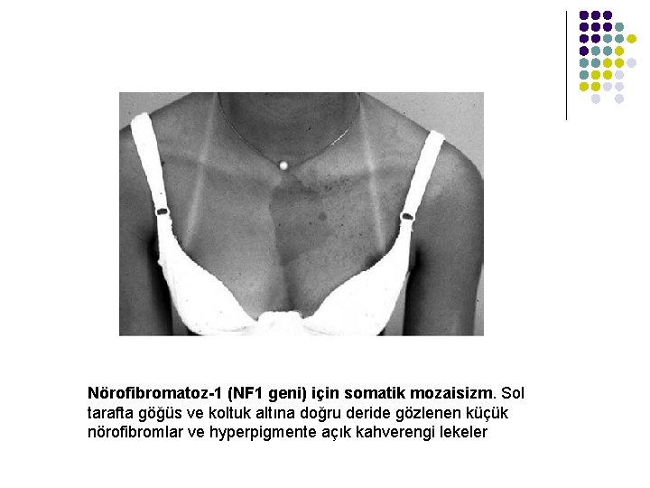 Nörofibromatoz-1 (NF 1 geni) için somatik mozaisizm. Sol tarafta göğüs ve koltuk altına doğru