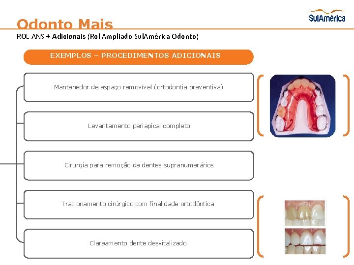 Odonto Mais ROL ANS + Adicionais (Rol Ampliado Sul. América Odonto) EXEMPLOS – PROCEDIMENTOS