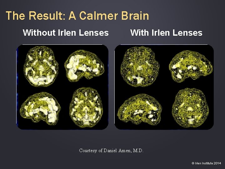 The Result: A Calmer Brain Without Irlen Lenses With Irlen Lenses Courtesy of Daniel