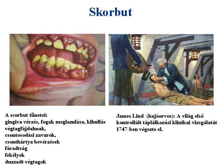 Skorbut A scorbut tünetei: gingiva vérzés, fogak meglazulása, kihullás végtagfájdalmak, csontosodási zavarok, csonthártya bevérzések