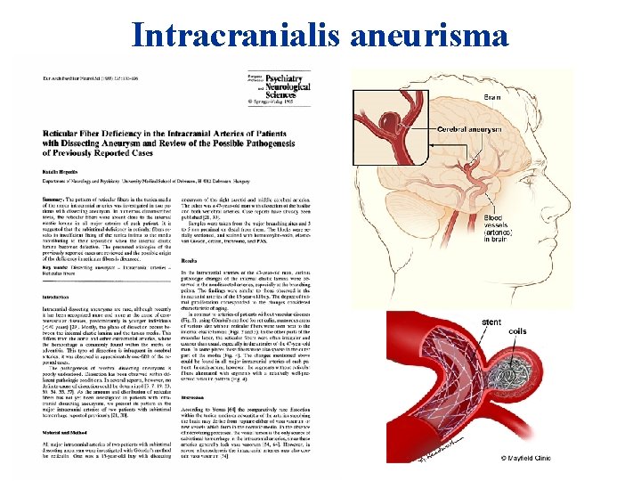 Intracranialis aneurisma 