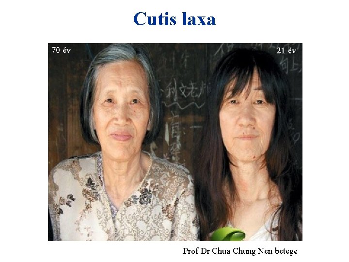 Cutis laxa 70 év 21 év Prof Dr Chua Chung Nen betege 