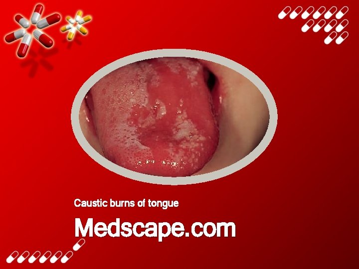 Caustic burns of tongue Medscape. com 