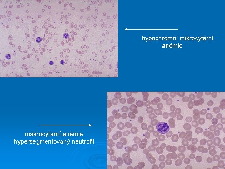 hypochromní mikrocytární anémie makrocytární anémie hypersegmentovaný neutrofil 