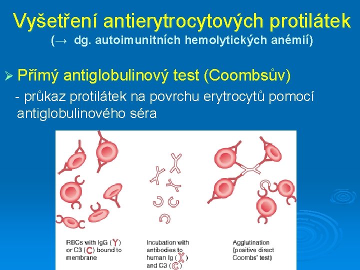 Vyšetření antierytrocytových protilátek (→ dg. autoimunitních hemolytických anémií) Ø Přímý antiglobulinový test (Coombsův) -