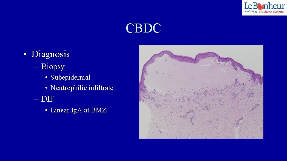 CBDC • Diagnosis – Biopsy • Subepidermal • Neutrophilic infiltrate – DIF • Linear