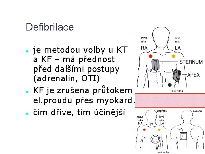 Defibrilace je metodou volby u KT a KF – má přednost před dalšími postupy
