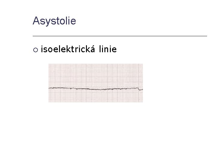 Asystolie isoelektrická linie 