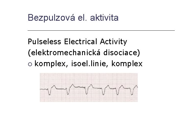 Bezpulzová el. aktivita Pulseless Electrical Activity (elektromechanická disociace) komplex, isoel. linie, komplex 