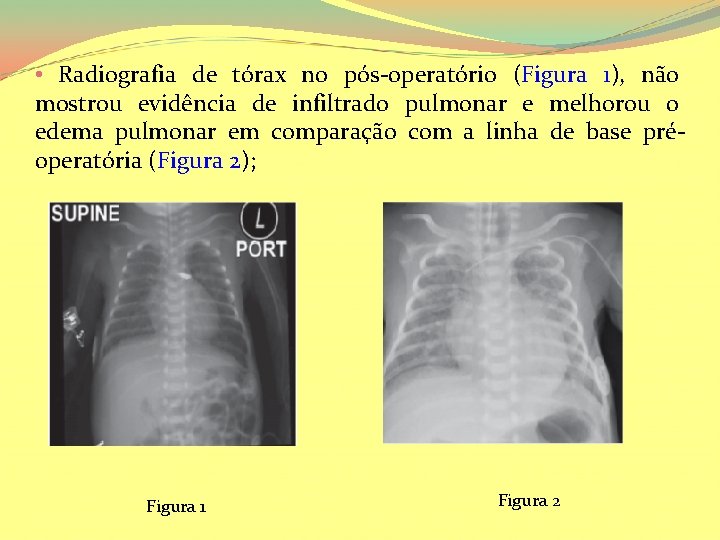  • Radiografia de tórax no pós-operatório (Figura 1), não mostrou evidência de infiltrado