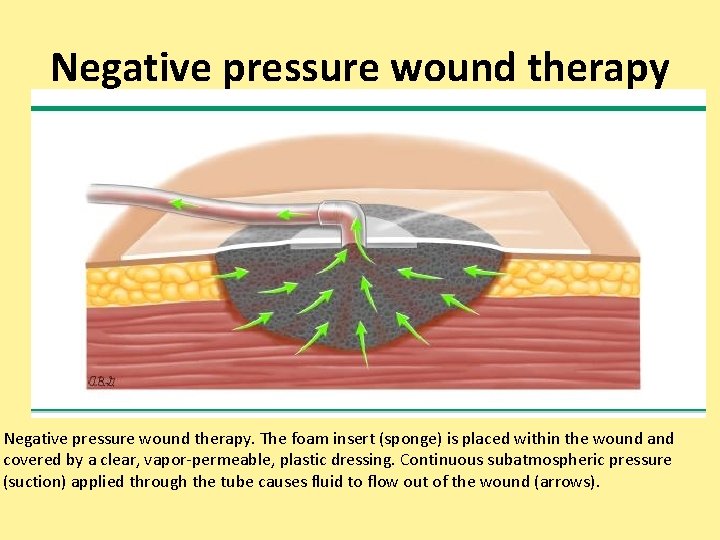 Negative pressure wound therapy. The foam insert (sponge) is placed within the wound and