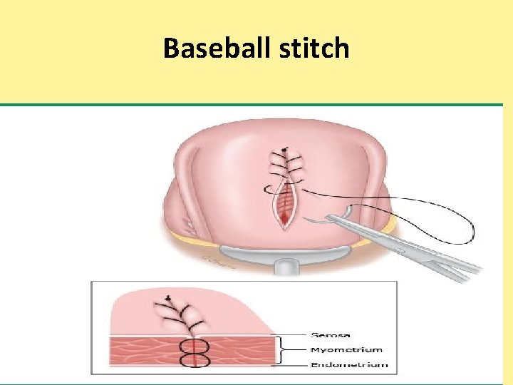 Baseball stitch 