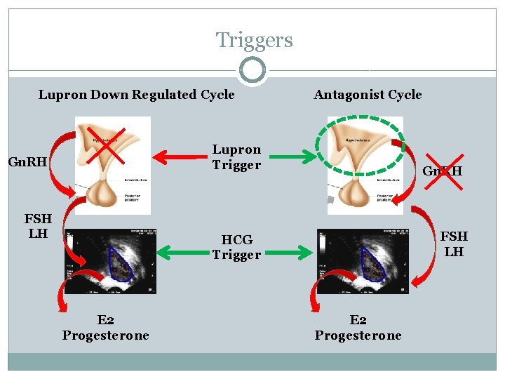 Triggers Lupron Down Regulated Cycle Antagonist Cycle Lupron Trigger Gn. RH FSH LH HCG