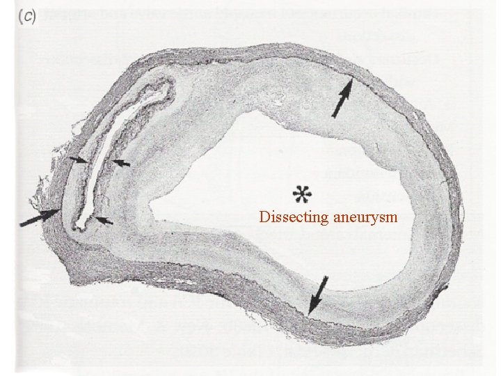 Dissecting aneurysm 