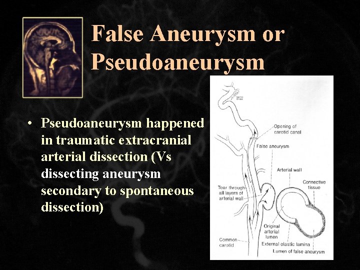 False Aneurysm or Pseudoaneurysm • Pseudoaneurysm happened in traumatic extracranial arterial dissection (Vs dissecting