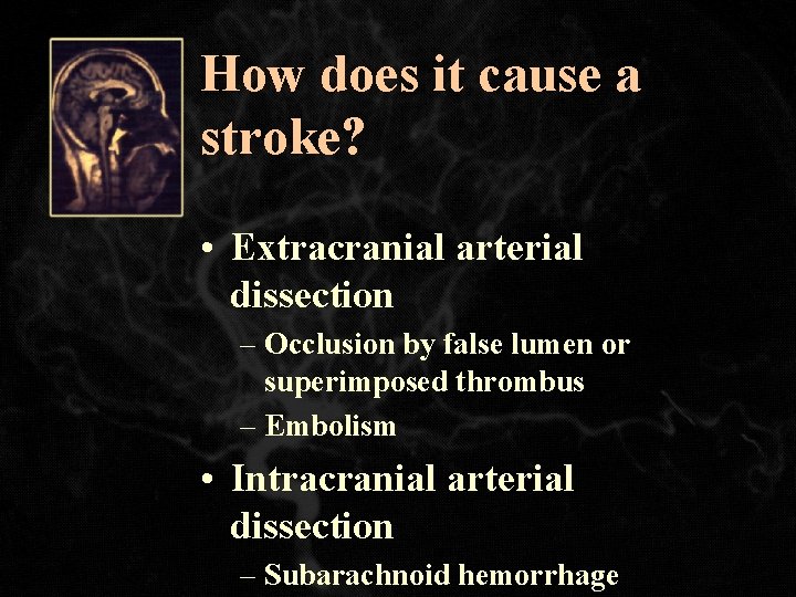 How does it cause a stroke? • Extracranial arterial dissection – Occlusion by false
