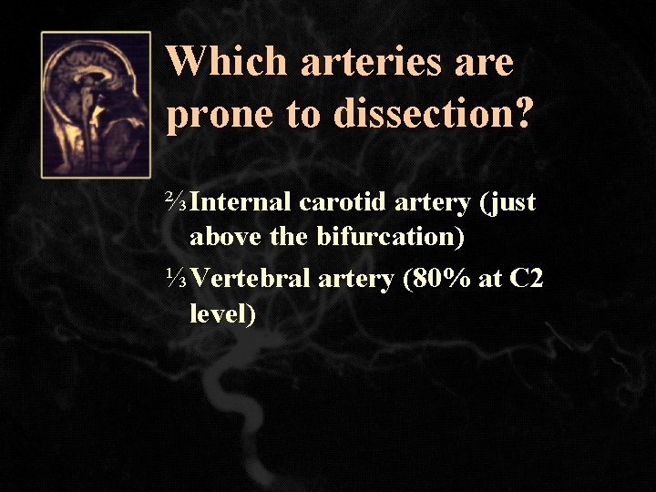 Which arteries are prone to dissection? ⅔ Internal carotid artery (just above the bifurcation)