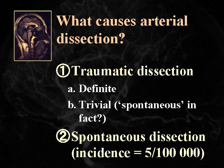 What causes arterial dissection? ① Traumatic dissection a. Definite b. Trivial (‘spontaneous’ in fact?