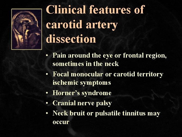 Clinical features of carotid artery dissection • Pain around the eye or frontal region,