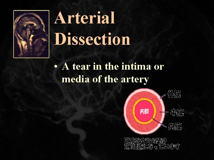 Arterial Dissection • A tear in the intima or media of the artery 
