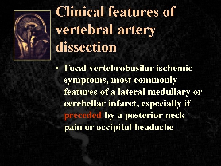 Clinical features of vertebral artery dissection • Focal vertebrobasilar ischemic symptoms, most commonly features