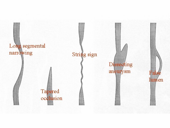Long segmental narrowing String sign Dissecting aneurysm Tapered occlusion False lumen 