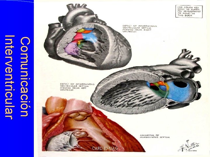 Comunicación Interventricular CARDIO-UAG 