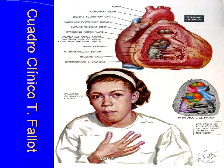Cuadro Clínico T. Fallot CARDIO-UAG 