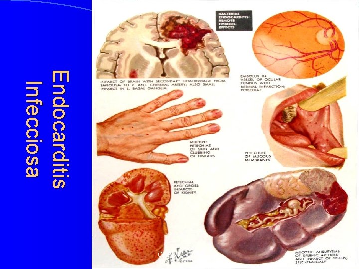 E n d o ca r d i t i s Infecciosa CARDIO-UAG 
