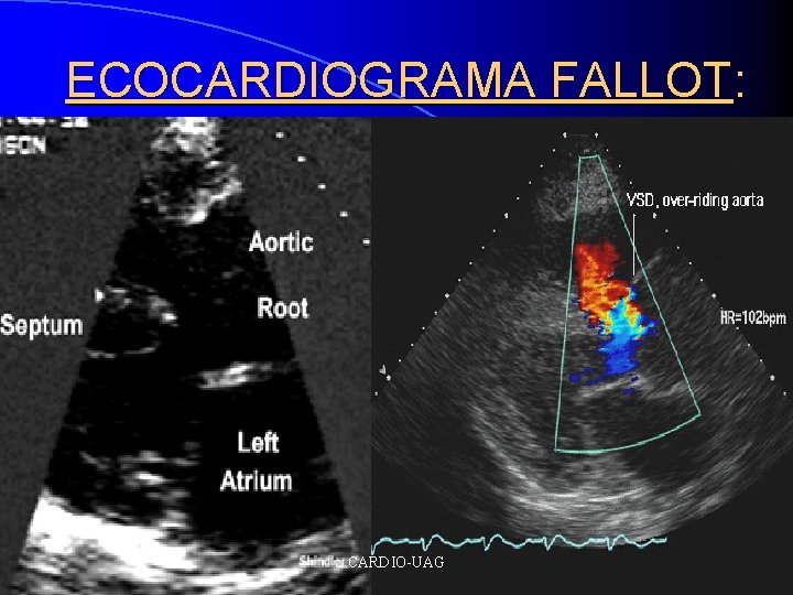 ECOCARDIOGRAMA FALLOT: CARDIO-UAG 