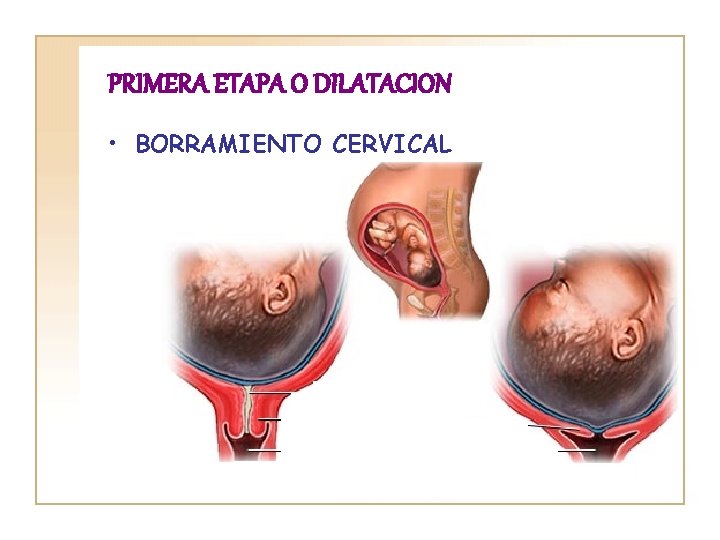 PRIMERA ETAPA O DILATACION • BORRAMIENTO CERVICAL 