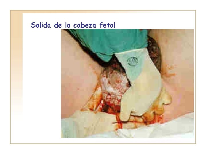 Salida de la cabeza fetal 