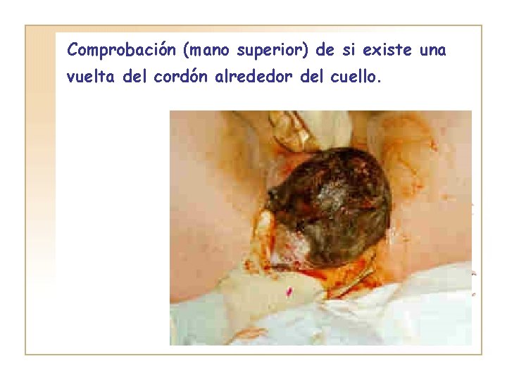 Comprobación (mano superior) de si existe una vuelta del cordón alrededor del cuello. 