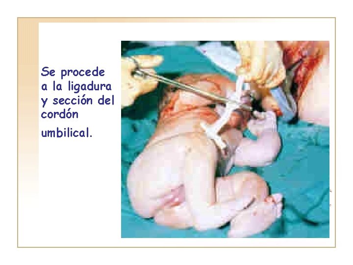 Se procede a la ligadura y sección del cordón umbilical. 