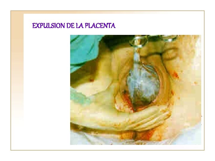 EXPULSION DE LA PLACENTA 