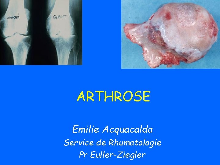 ARTHROSE Emilie Acquacalda Service de Rhumatologie Pr Euller-Ziegler 