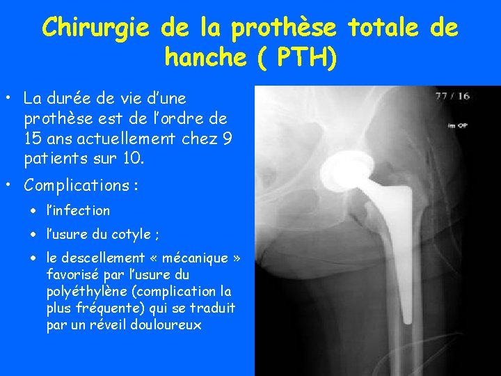 Chirurgie de la prothèse totale de hanche ( PTH) • La durée de vie
