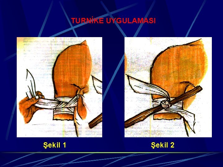 TURNİKE UYGULAMASI Şekil 1 Şekil 2 
