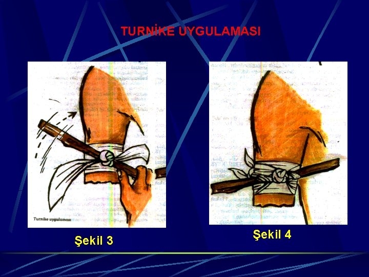 TURNİKE UYGULAMASI Şekil 3 Şekil 4 