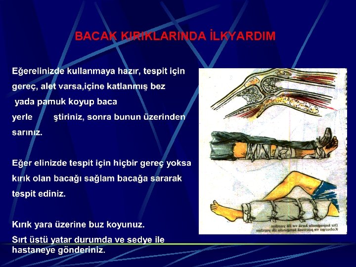 BACAK KIRIKLARINDA İLKYARDIM 