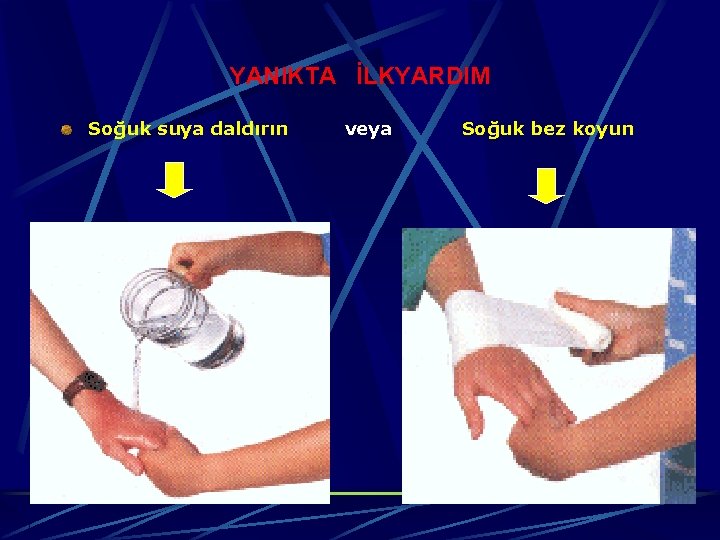 YANIKTA İLKYARDIM Soğuk suya daldırın veya Soğuk bez koyun 